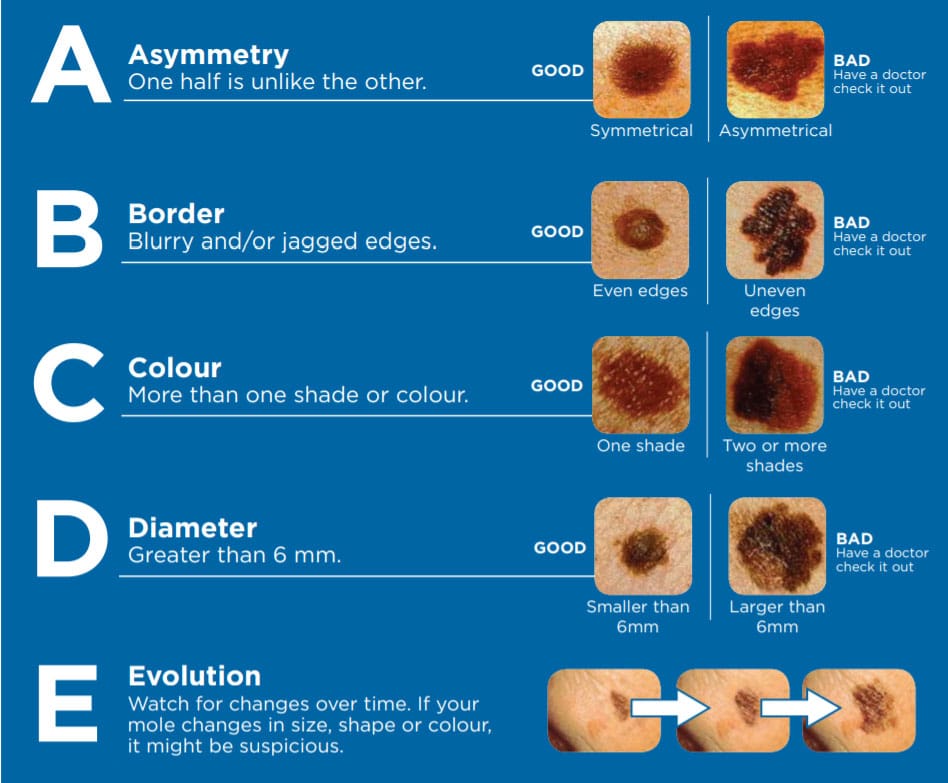 Skin cancer early detection